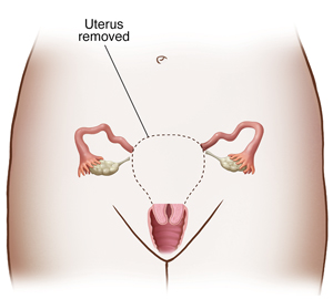 Front view of woman's pelvis showing reproductive tract. Dotted line shows organs removed in supracervical hysterectomy.