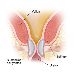 Primer plano de un corte transversal del cuello de la vejiga donde se muestra cómo la sustancia ocluyente mantiene cerrado el cuello de la vejiga.