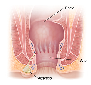 Corte transversal del ano donde se observa el absceso.